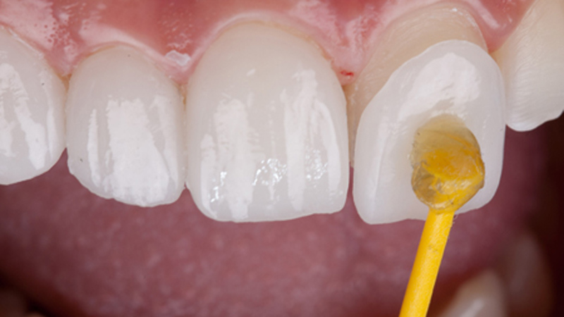LAMİNATE VENEER