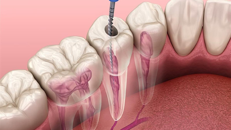 ENDODONTİK TEDAVİLER