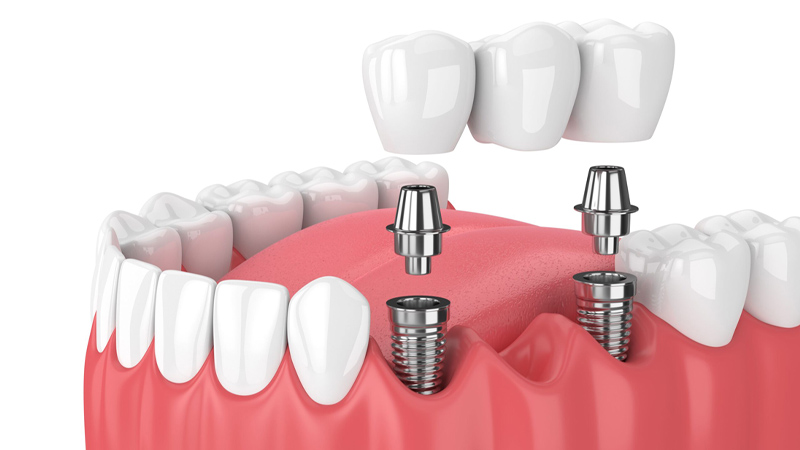 Dental İmplant